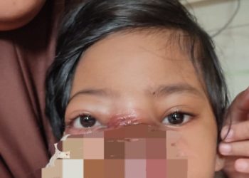 Mengidap Tumor di Wajah, Bocah Perempuan di Sukabumi Butuh Uluran Tangan