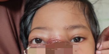 Mengidap Tumor di Wajah, Bocah Perempuan di Sukabumi Butuh Uluran Tangan