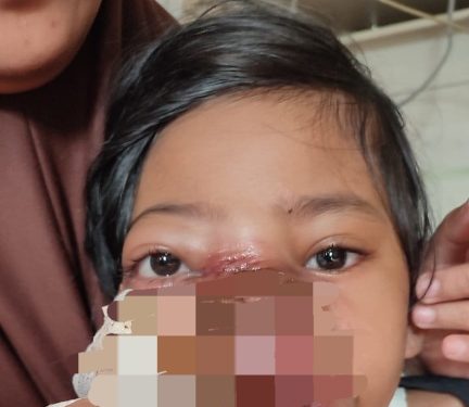 Mengidap Tumor di Wajah, Bocah Perempuan di Sukabumi Butuh Uluran Tangan