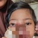 Mengidap Tumor di Wajah, Bocah Perempuan di Sukabumi Butuh Uluran Tangan