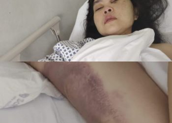 PMI Asal Sukabumi Diduga Disiksa Majikan di Dubai, Kondisi Fisik Memprihatinkan