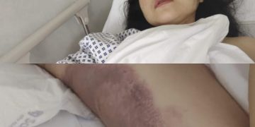 PMI Asal Sukabumi Diduga Disiksa Majikan di Dubai, Kondisi Fisik Memprihatinkan