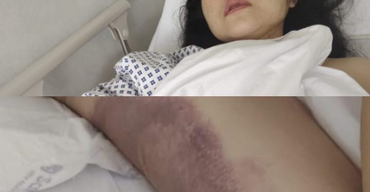 PMI Asal Sukabumi Diduga Disiksa Majikan di Dubai, Kondisi Fisik Memprihatinkan